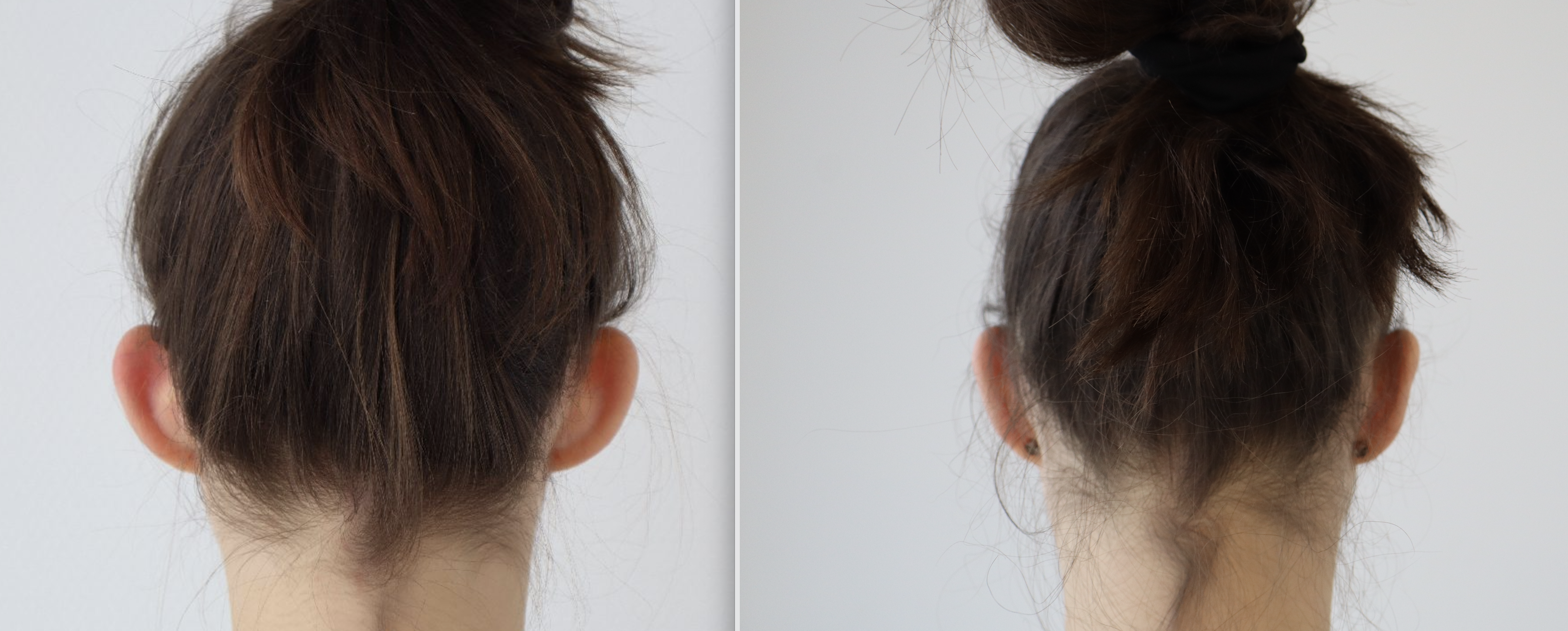 Avant/Après oreilles décollées